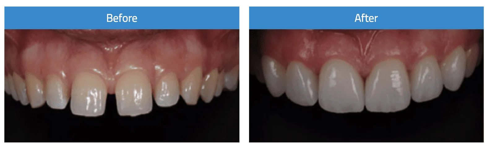 Before and after dental veneers