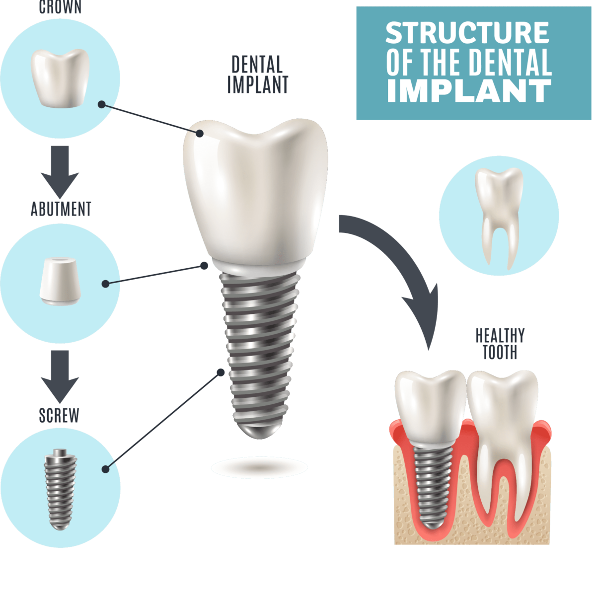 How Dental Implants Work – The Dentist, Implants, Veneers, Emergency Center