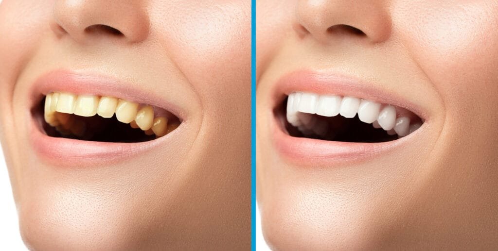 Teeth whitening treatment for a brighter smile