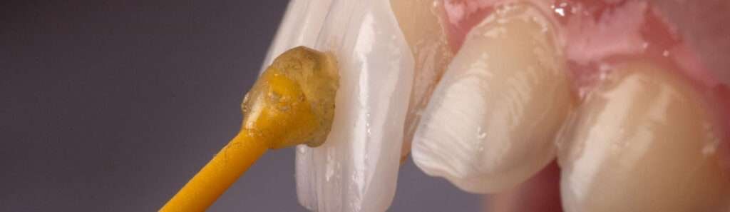 applying glue on dental veneers