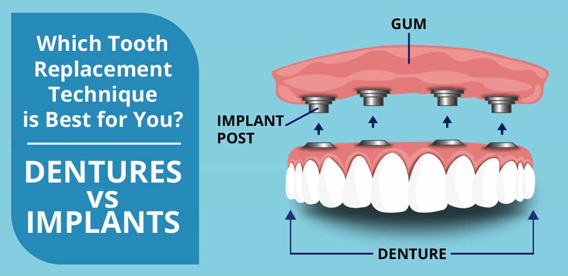 Dentures Vs Dental Implants – The Right Choice For You – The Dentist 