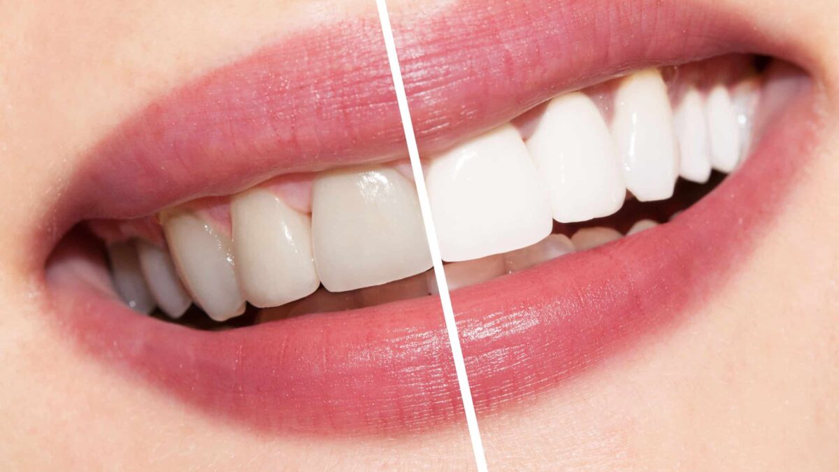 White Spots: What They Are and How To Get Rid Of Them - Center for  Restorative & Cosmetic Dentistry