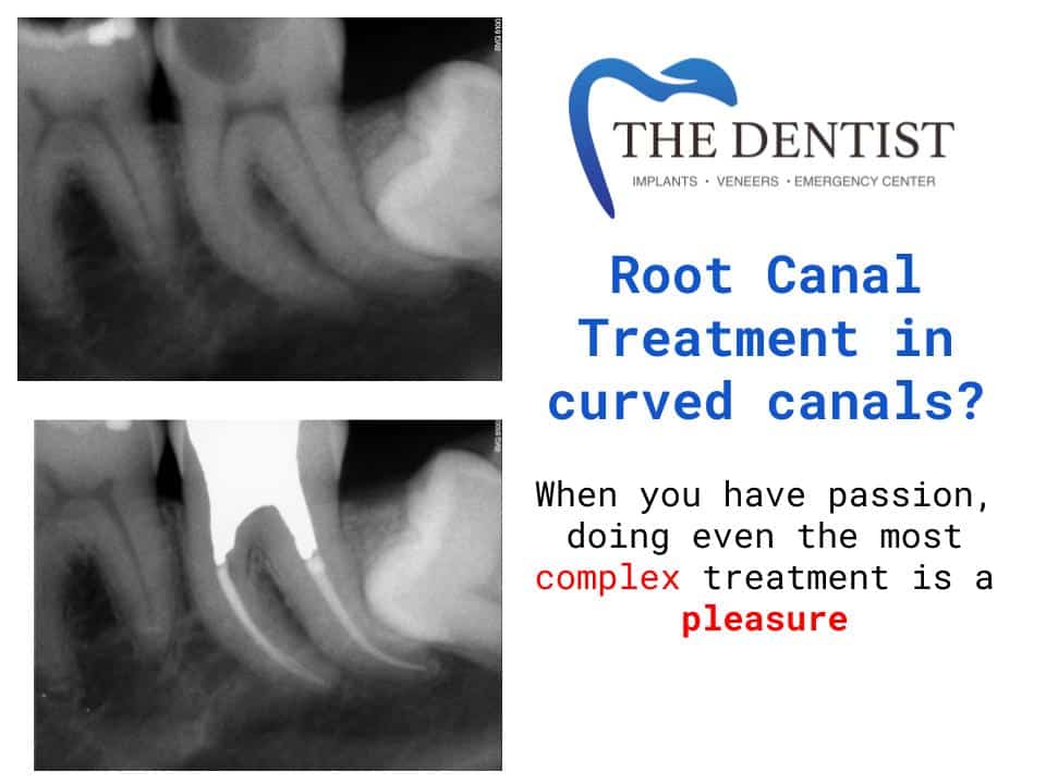 emergency root canal near me