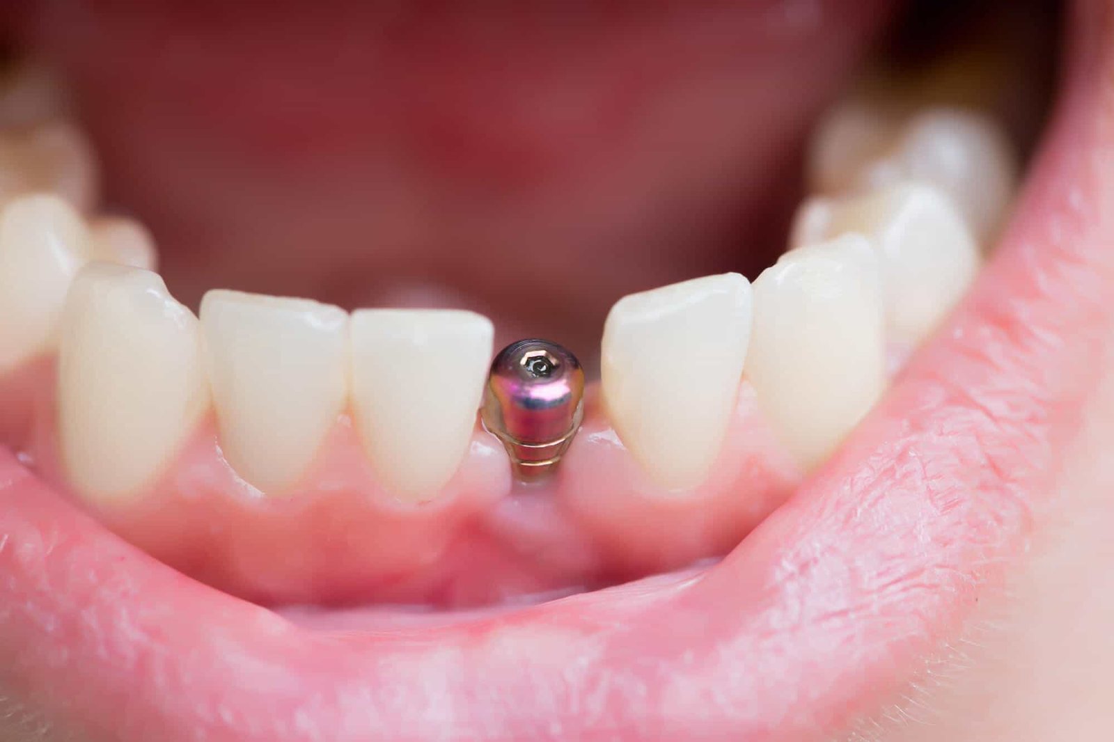 dental-implant-care