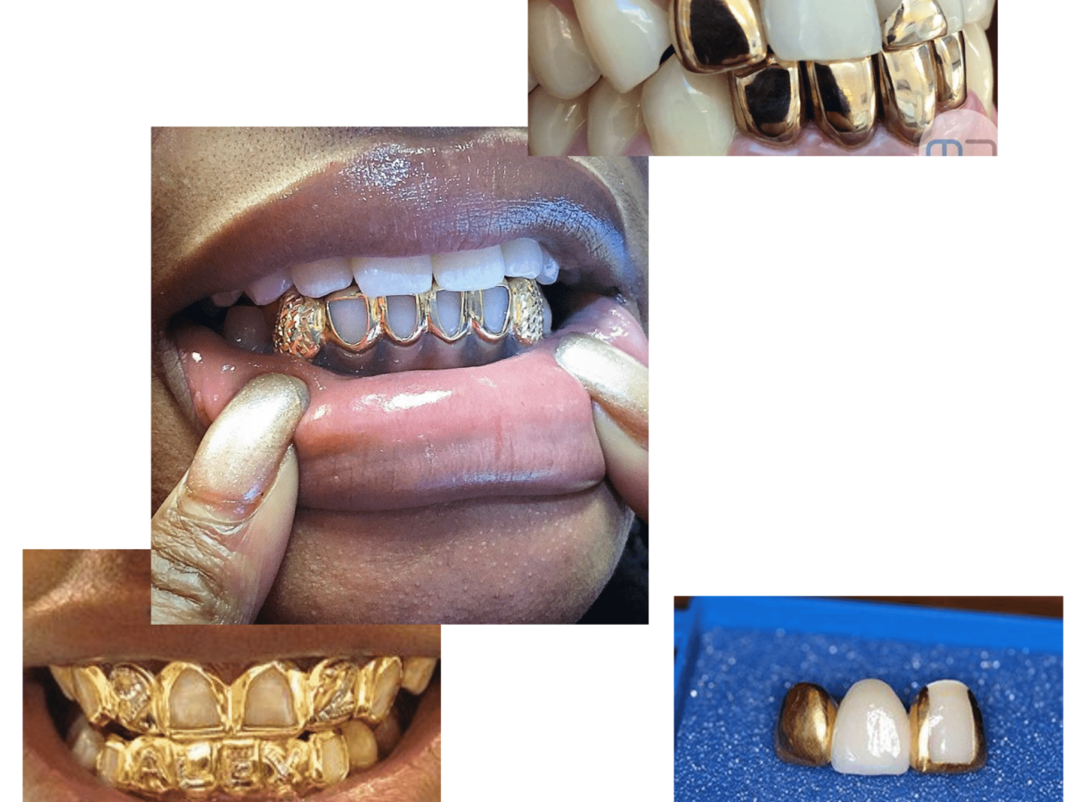gold tooth bridge