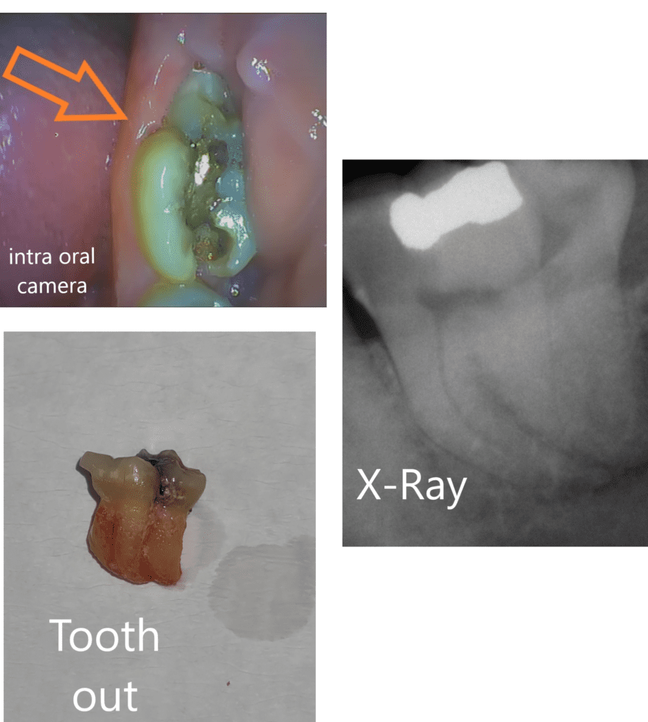 Collage showing a fused wisdom tooth extraction case