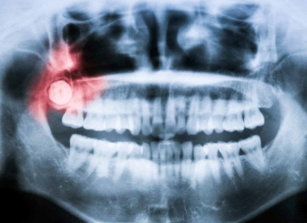 Close-up x-ray of an impacted wisdom tooth