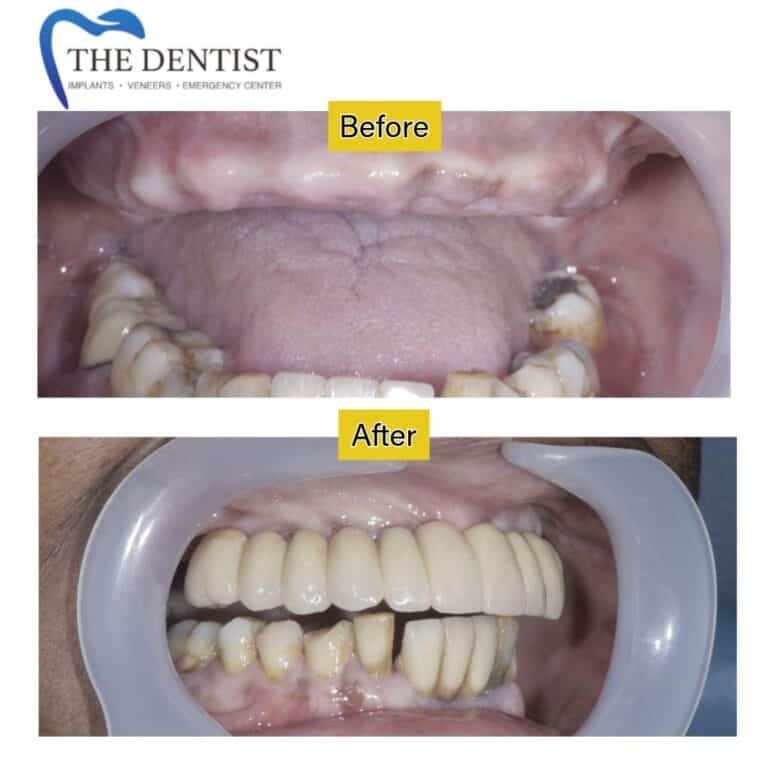 Before and after dental implant at The Dentist Birmingham