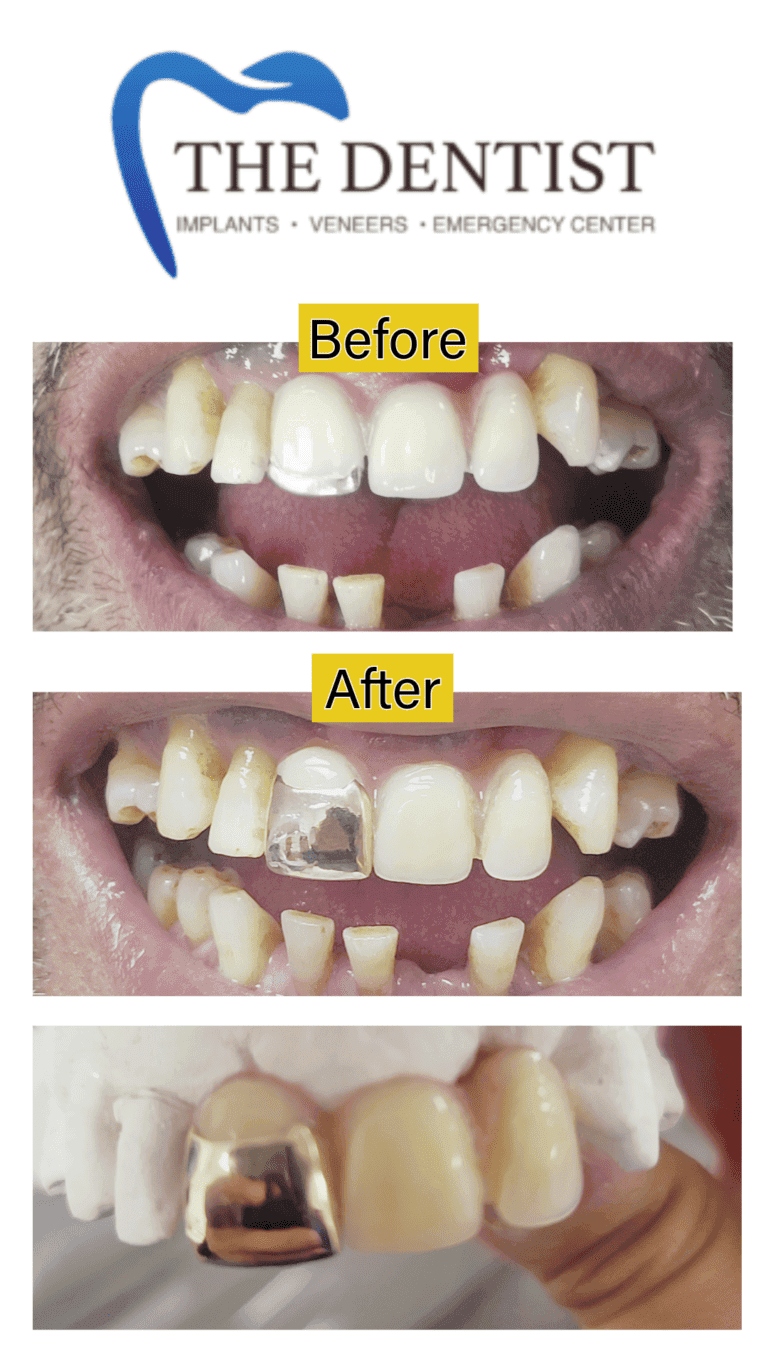 Gold dental restoration at The Dentist Birmingham