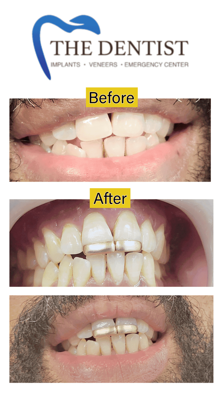 Gold dental restoration at The Dentist Birmingham