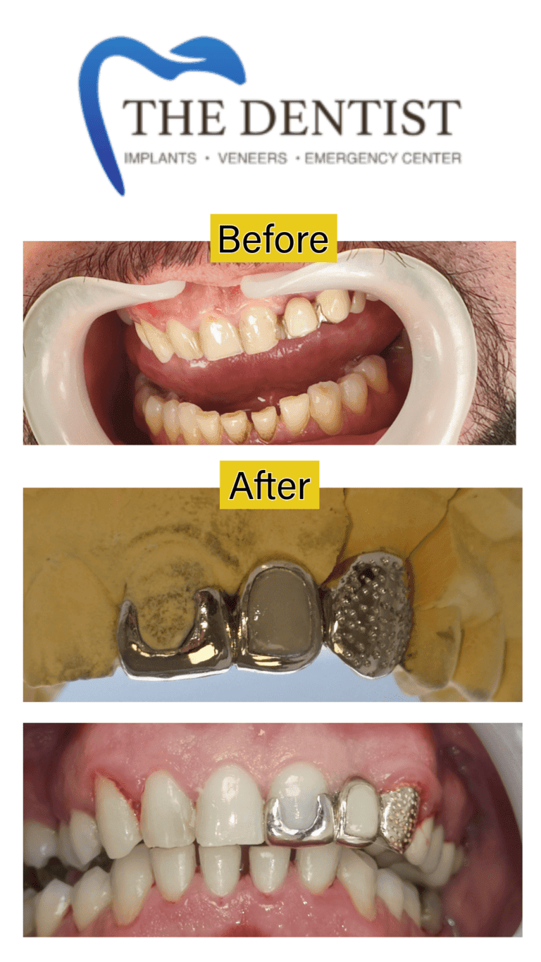 Gold dental restoration at The Dentist Birmingham