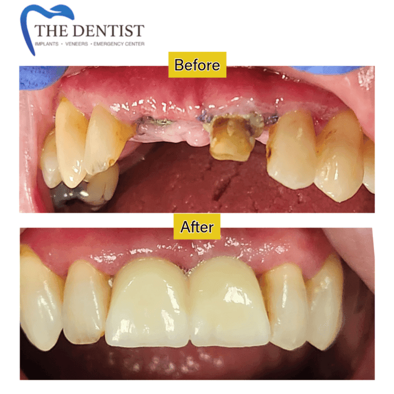 Before and after dental implant at The Dentist Birmingham