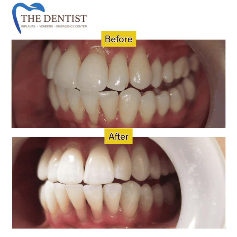 Before and after professional teeth whitening at The Dentist Birmingham