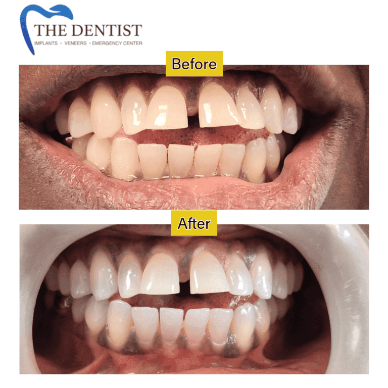 Before and after professional teeth whitening at The Dentist Birmingham