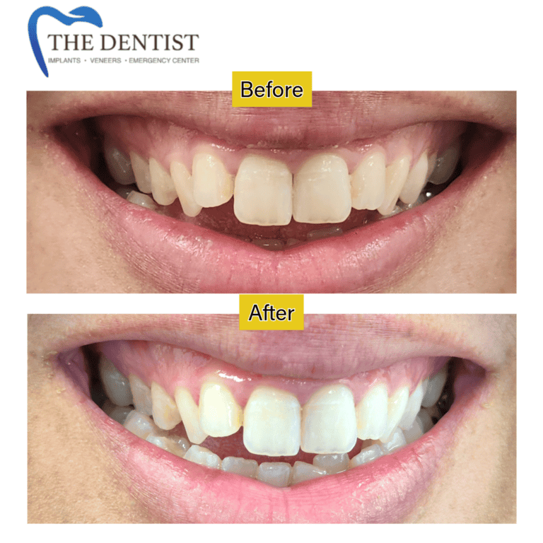 Before and after professional teeth whitening at The Dentist Birmingham
