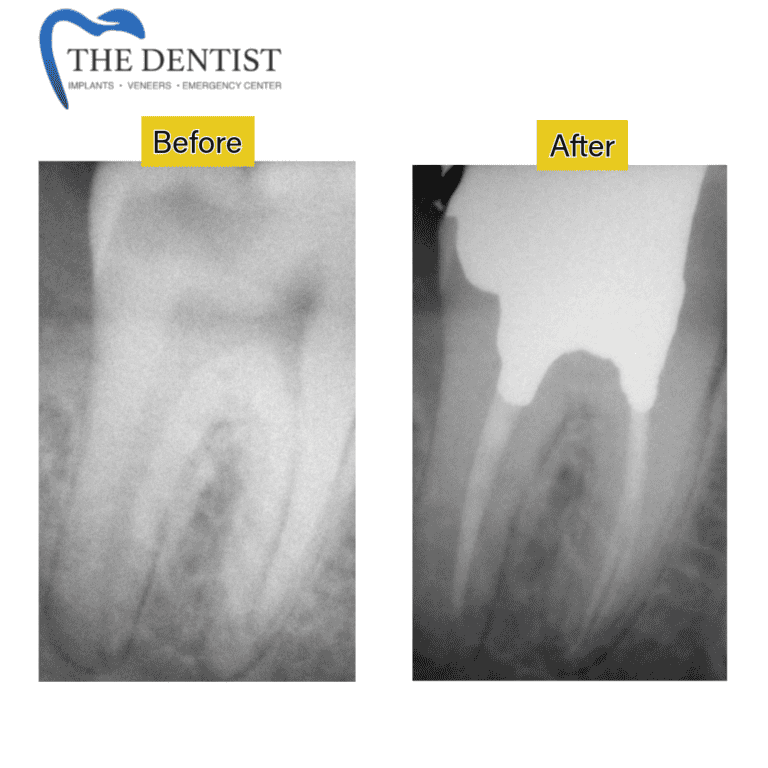 Before and after root canal treatment at The Dentist Birmingham