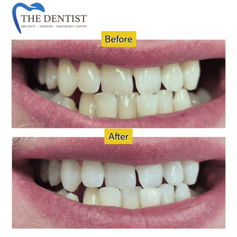 Before and after professional teeth whitening at The Dentist Birmingham