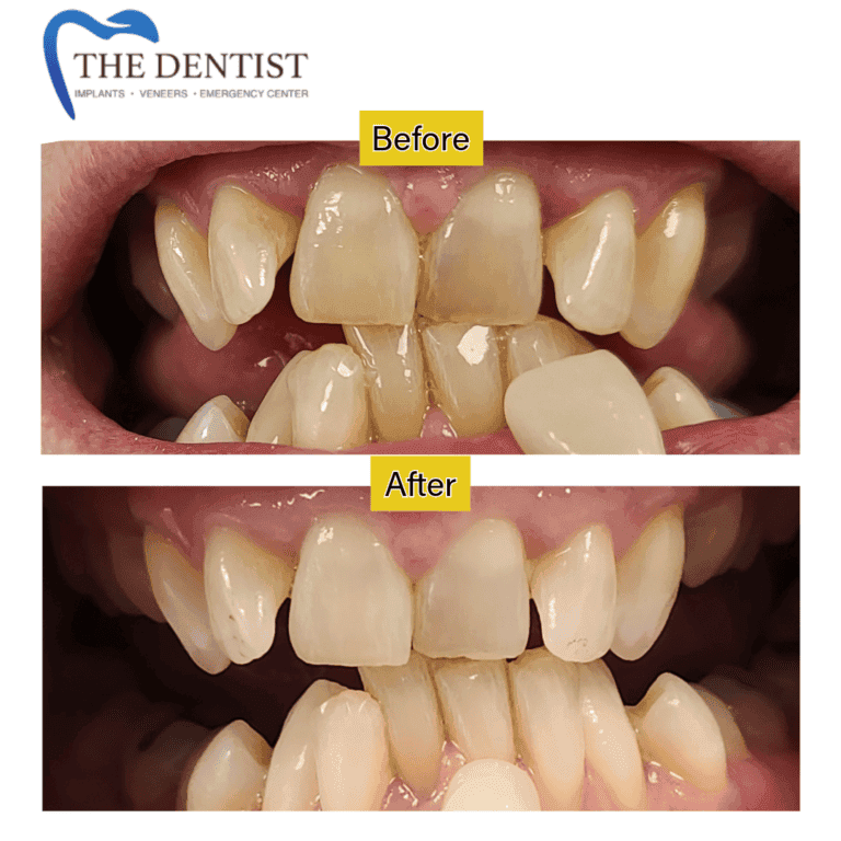 Before and after professional teeth whitening at The Dentist Birmingham