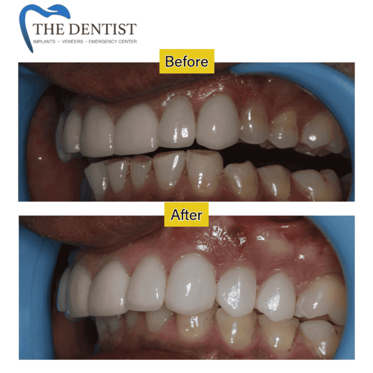 Before and after crowns and veneers at The Dentist Birmingham