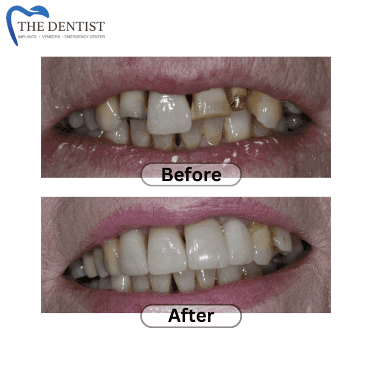 Before and after full arch dental implants at The Dentist Birmingham