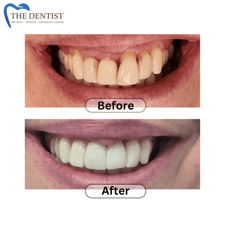 Before and after dental implant at The Dentist Birmingham