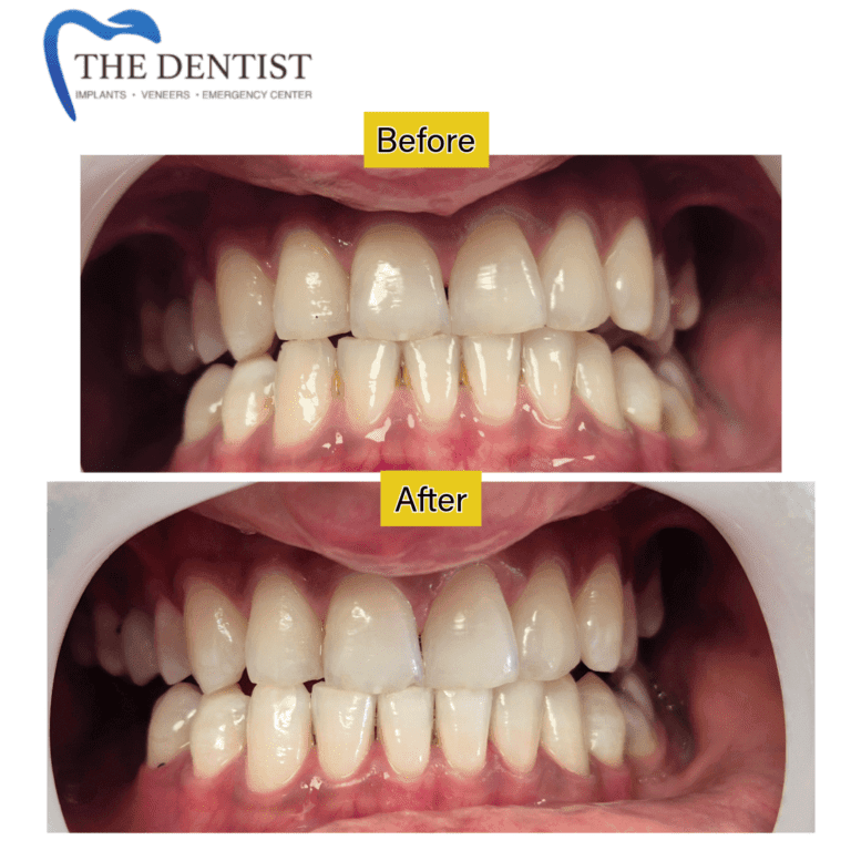 Before and after professional teeth whitening at The Dentist Birmingham