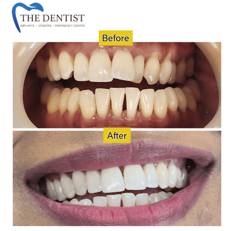 Before and after braces treatment at The Dentist Birmingham