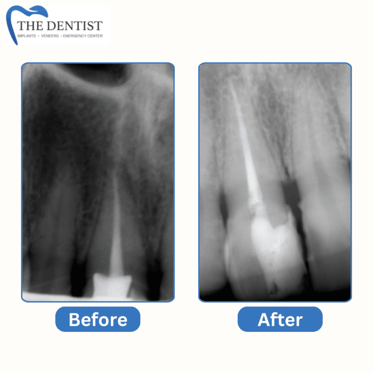 Before and after root canal treatment at The Dentist Birmingham