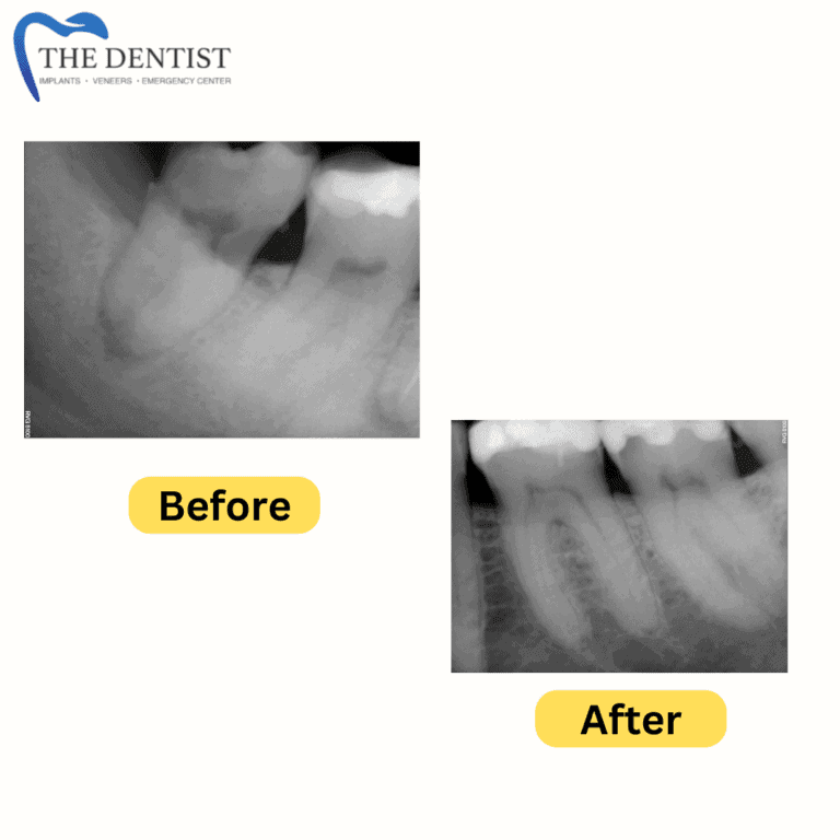 Before and after root canal treatment at The Dentist Birmingham