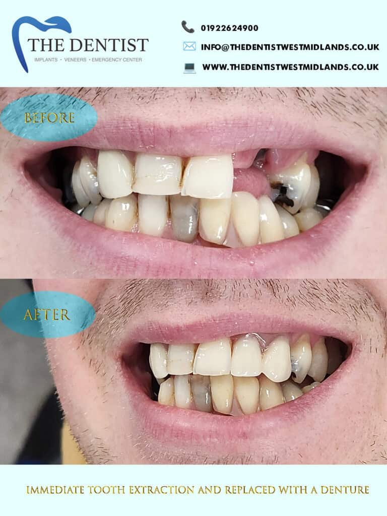 Before and after dentures at The Dentist Birmingham