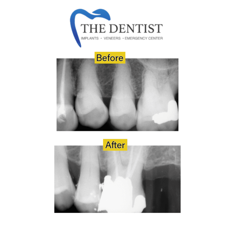 Before and after root canal treatment at The Dentist Birmingham