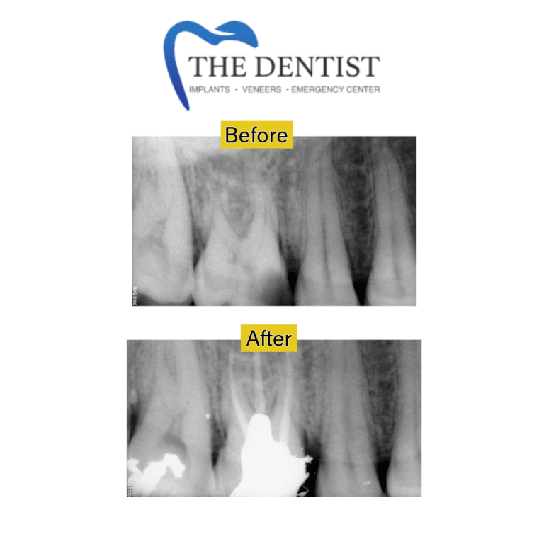 Before and after root canal treatment at The Dentist Birmingham