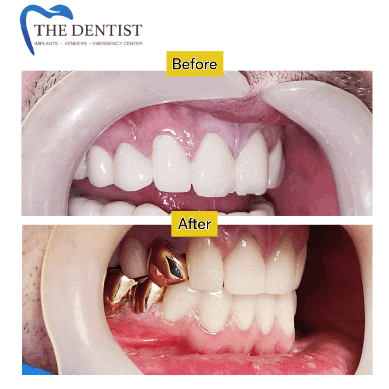 Gold dental restoration at The Dentist Birmingham