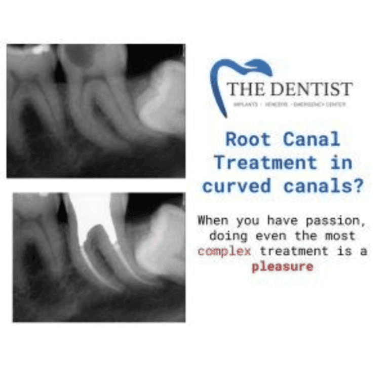Before and after root canal treatment at The Dentist Birmingham