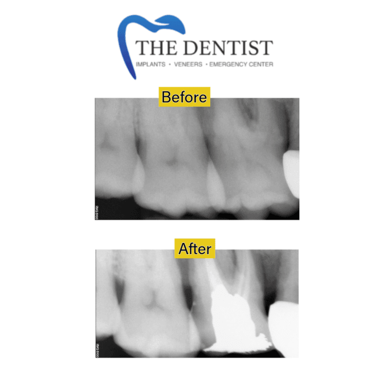 Before and after root canal treatment at The Dentist Birmingham