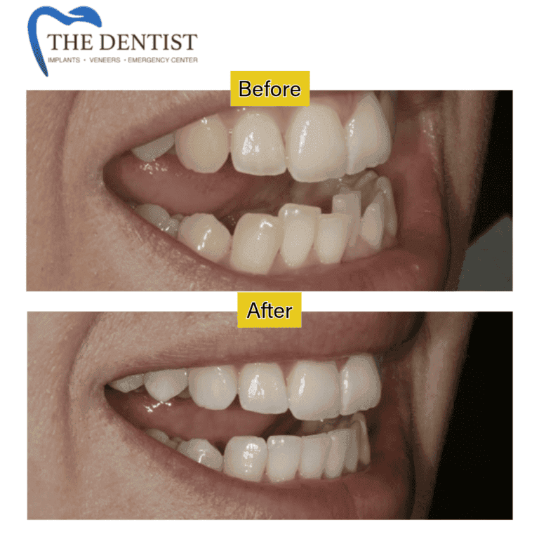 Before and after braces treatment at The Dentist Birmingham