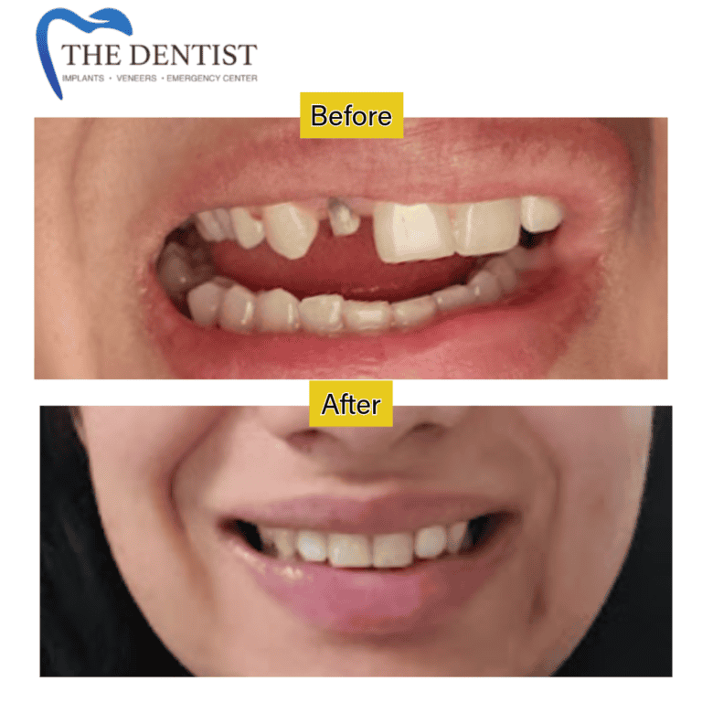 Before and after crowns and veneers at The Dentist Birmingham