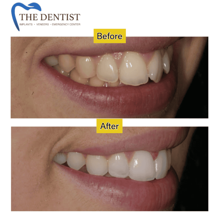 Before and after braces treatment at The Dentist Birmingham
