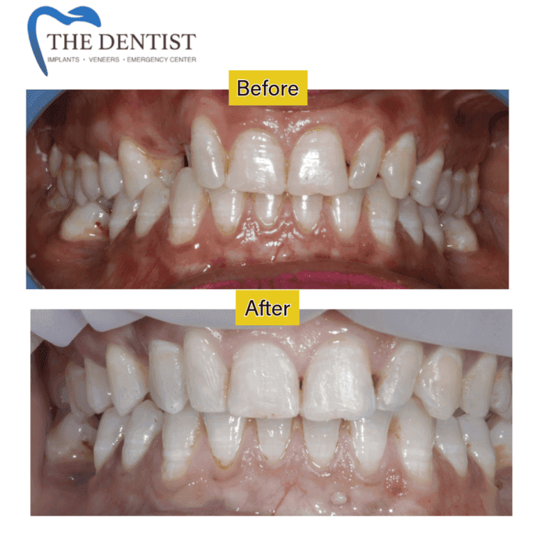 Before and after braces treatment at The Dentist Birmingham