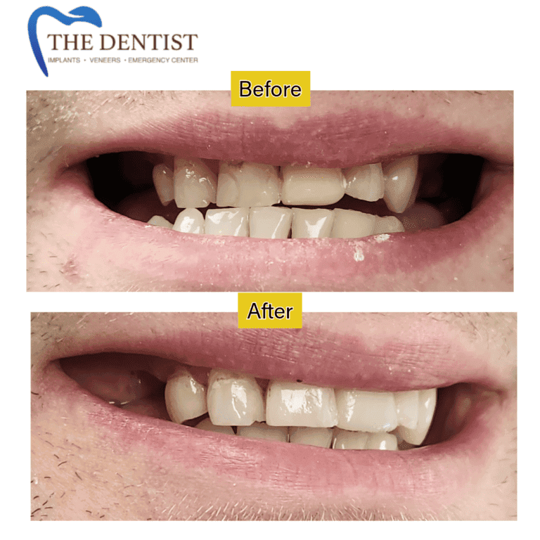 Before and after composite bonding at The Dentist Birmingham