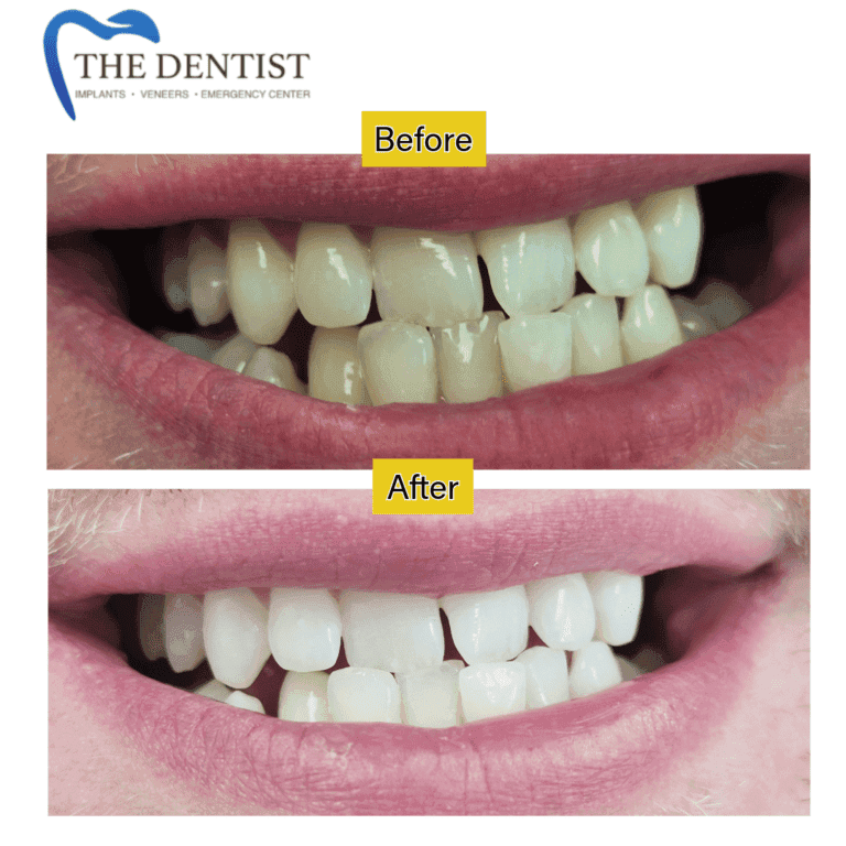 Before and after professional teeth whitening at The Dentist Birmingham