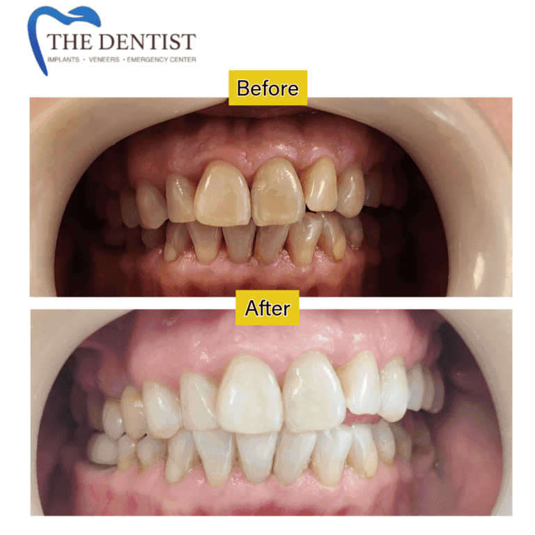 Before and after professional teeth whitening at The Dentist Birmingham