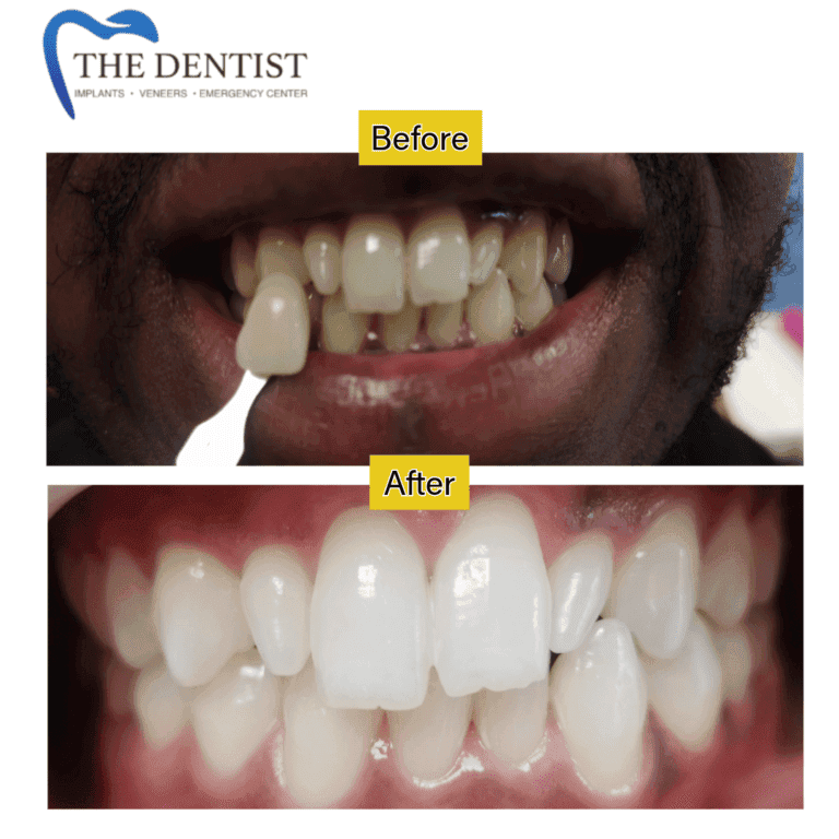 Before and after professional teeth whitening at The Dentist Birmingham
