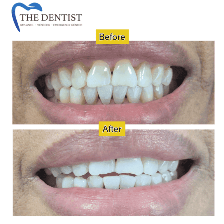 Before and after professional teeth whitening at The Dentist Birmingham