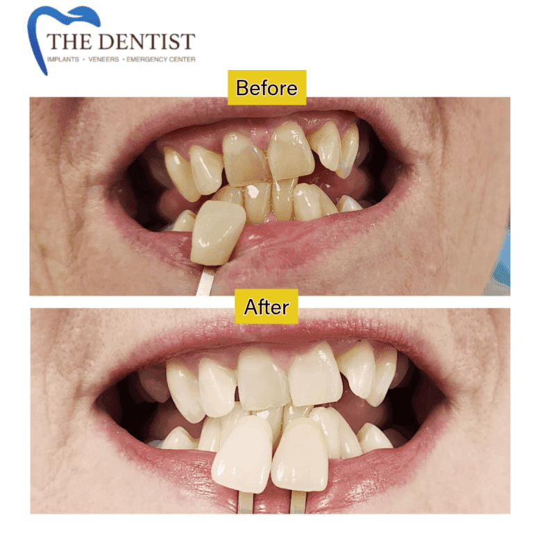 Before and after professional teeth whitening at The Dentist Birmingham