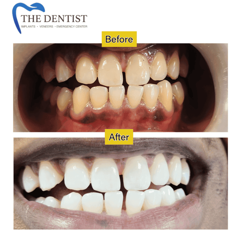 Before and after professional teeth whitening at The Dentist Birmingham