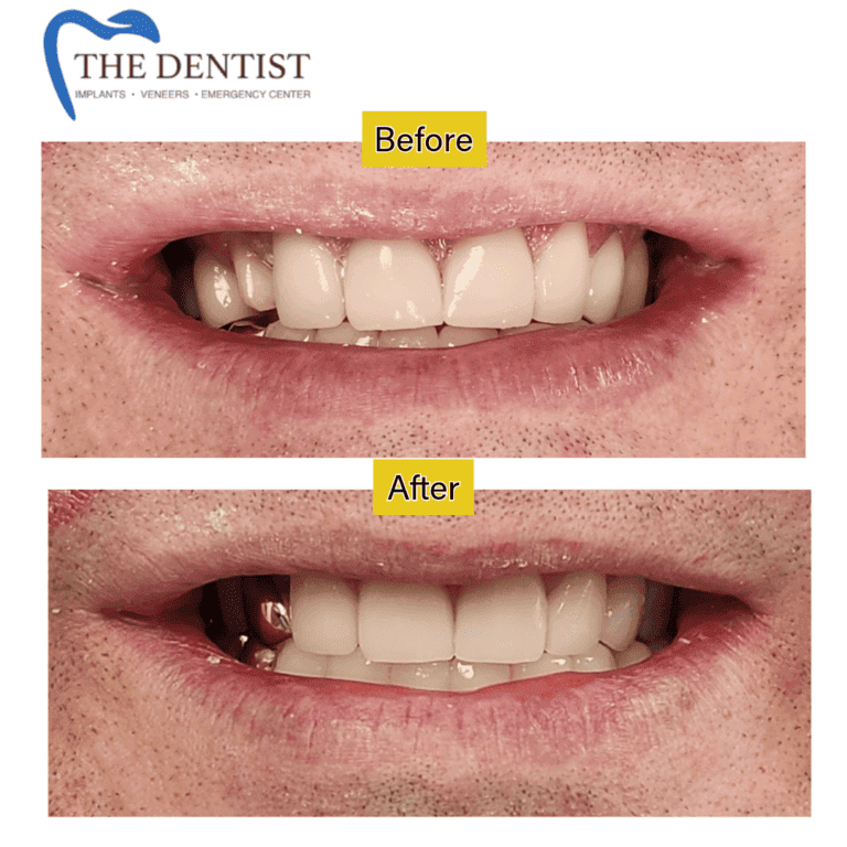 Gold dental restoration at The Dentist Birmingham