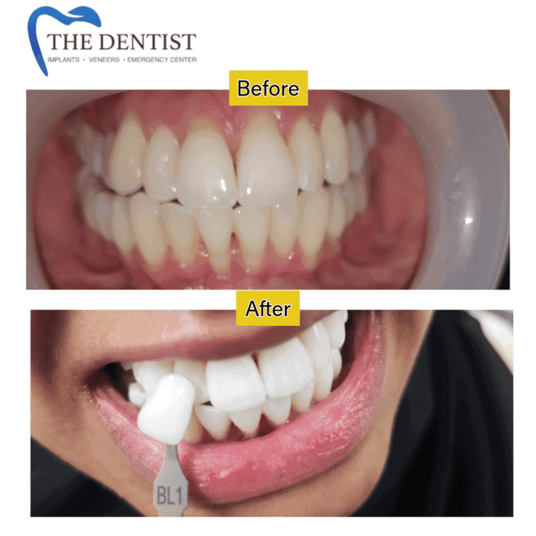 Before and after professional teeth whitening at The Dentist Birmingham