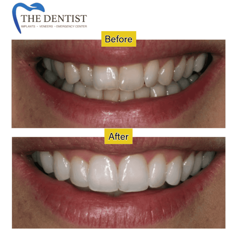 Before and after braces treatment at The Dentist Birmingham