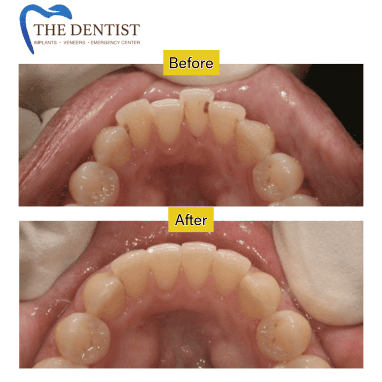 Before and after braces treatment at The Dentist Birmingham
